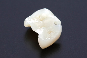 オールセラミックインレー