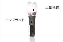 インプラント