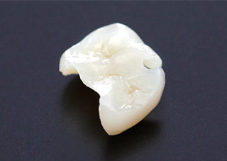 ジルコニアインレー